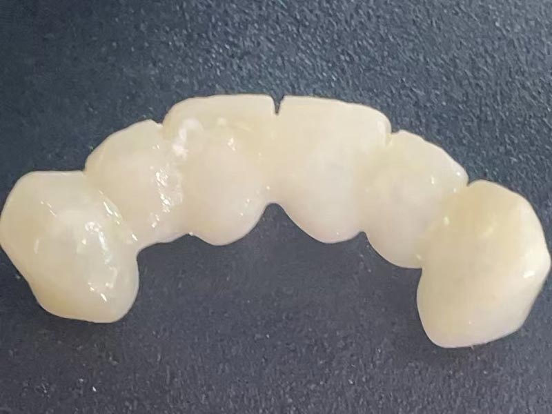 Що таке «тимчасова коронка»? Навіщо вам це потрібно?