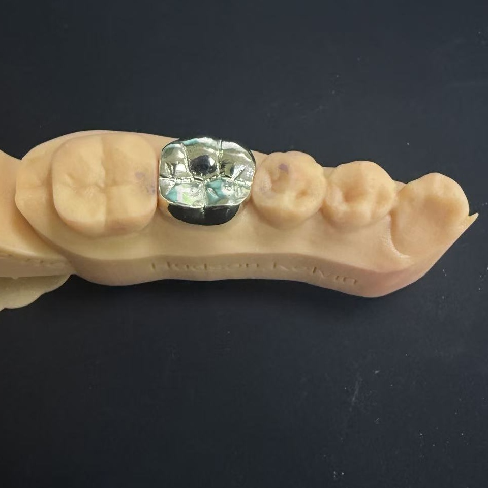 Золоті коронки: дорогоцінний метал для реставрації зубів протягом усього життя