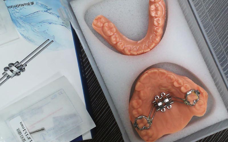 Зрозумійте розширення скелета MSE із WM Dental Lab