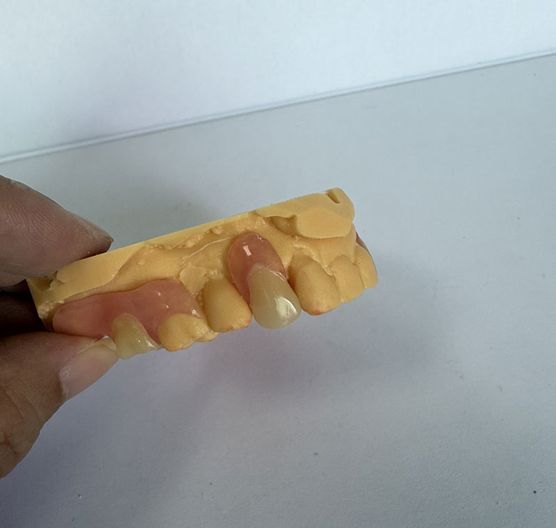 Valplast Partials у WM Dental Lab