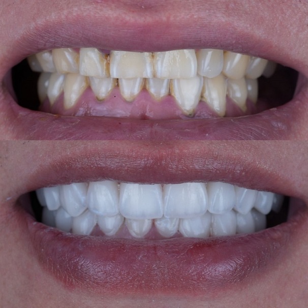 Emax Layered Veneers Esthetic China Dental Lab робота