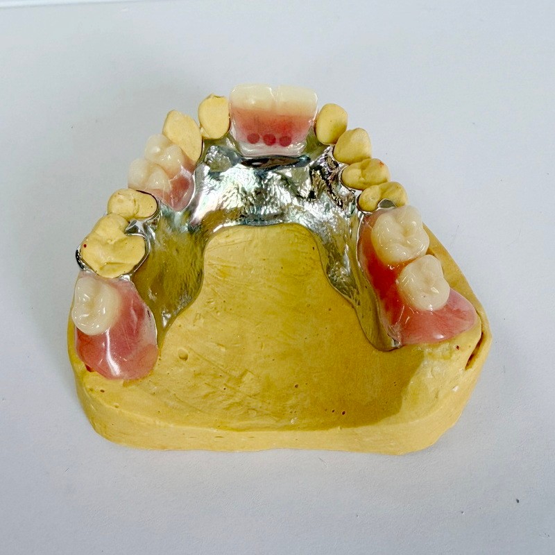 Частковий каркас для знімної реставрації